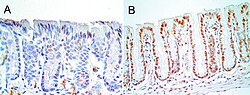 Colonic epithelium from a mouse not undergoing colonic tumorigenesis (A), and a mouse that is undergoing colonic tumorigenesis (B). Cell nuclei are stained dark blue with hematoxylin (for nucleic acid) and immunostained brown for 8-oxo-dG. The level of 8-oxo-dG was graded in the nuclei of colonic crypt cells on a scale of 0-4. Mice not undergoing tumorigenesis had crypt 8-oxo-dG at levels 0 to 2 (panel A shows level 1) while mice progressing to colonic tumors had 8-oxo-dG in colonic crypts at levels 3 to 4 (panel B shows level 4) Tumorigenesis was induced by adding deoxycholate to the mouse diet to give a level of deoxycholate in the mouse colon similar to the level in the colon of humans on a high fat diet.[12] The images were made from original photomicrographs.