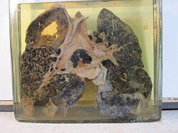 Miner's lung with silicosis and tuberculosis (Basque Museum of the History of Medicine and Science, Spain)