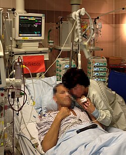 This patient of an intensive care unit of a German hospital could not eat due to a prior surgical operation of the abdominal region which was complicated by a severe sepsis. He received antibiotics, parenteral nutrition and pain killers via automated injection employing syringe drivers (background, right).
