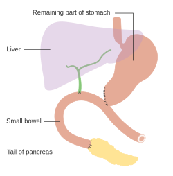 How the pancreas and bowel are joined back together after a Whipple's operation