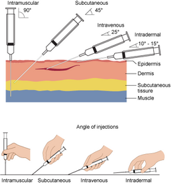 A needle for intravenous access should be inserted at an approximately 25-degree angle.