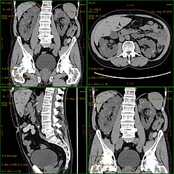CT scan showing autosomal dominant polycystic kidney disease