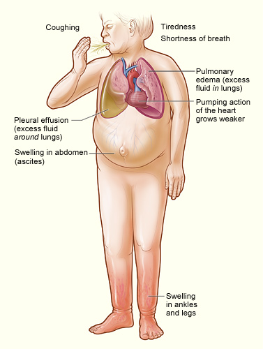 Signs and symptoms of severe heart failure
