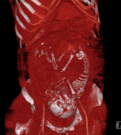 CT scanning (volume rendered in this case) confers a radiation dose to the developing fetus.