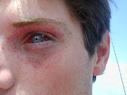 Mask squeeze - a mild form of barotrauma
