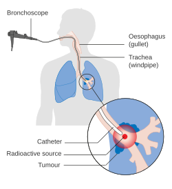 A machine attached to a tube that goes into a person's mouth and into a bronchus. At the end, an object emits radiation at a lung tumor.