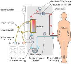 Schematic of a hemodialysis circuit
