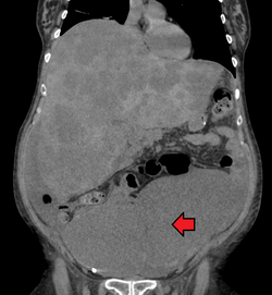 Colon cancer with extensive metastases to the liver