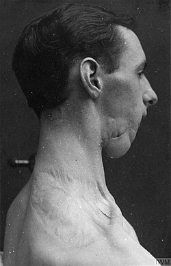 A patient after receiving plastic surgery from Harold Gillies, during World War I