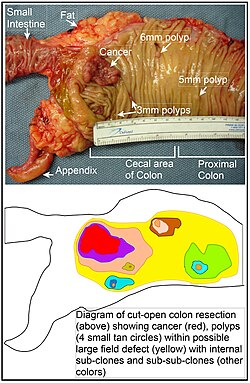 Longitudinally opened freshly resected colon segment showing a cancer and four polyps. Plus a schematic diagram indicating a likely field defect (a region of tissue that precedes and predisposes to the development of cancer) in this colon segment. The diagram indicates sub-clones and sub-sub-clones that were precursors to the tumors.