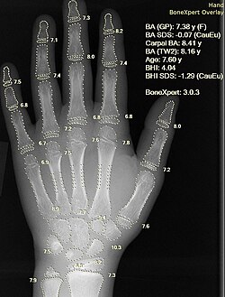 X-ray of a hand, with automatic calculation of bone age by a computer software
