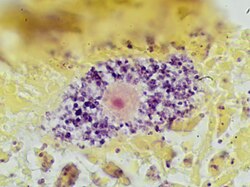 Gram stain of a macrophage with ingested S. epidermidis bacteria, seen as purple granules within its cytoplasm.