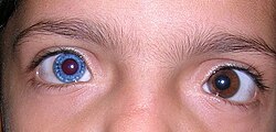 Two different eye colors are known as heterochromia iridum
