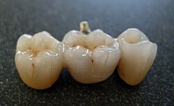 Dental porcelain bridge