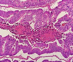 Micrograph of colorectal adenocarcinoma, showing "dirty necrosis"