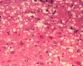 Brain tissue of a cow with BSE showing the typical microscopic "holes" in the grey matter