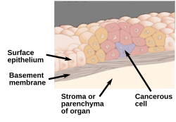Diagram of an in situ carcinoma, not having invaded beyond the basement membrane