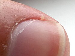 Thumbnail of the right hand with cuticle (left) and hangnail (top)