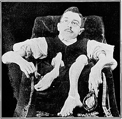 Severe limb deformities and contractures indicative of muscular dystrophy
