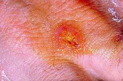 Tularemia lesion in human