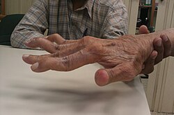 Hand deformity, sometimes called a swan deformity, in an elderly person with rheumatoid arthritis