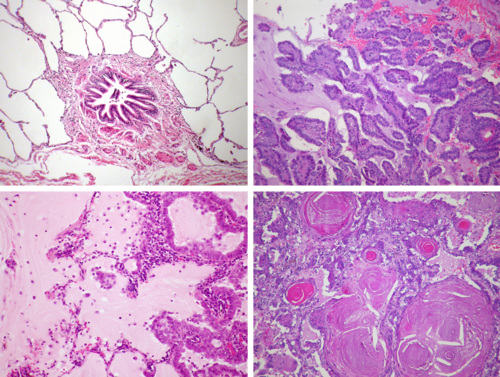 Microscope images of lung tissue. At top-left, healthy lung with clear air-filled alveoli. Others are full of tumor or material, per caption.