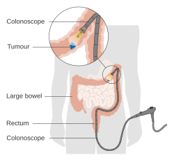 A diagram of a local resection of early stage colon cancer