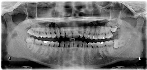 X-ray of the teeth and jaw showing the normal permanent teeth. The last two teeth on the patient's left (the dentist's right), 28 and 38 - the maxillary and mandibular third molars (popularly the upper and lower wisdom teeth) are severely impacted.
