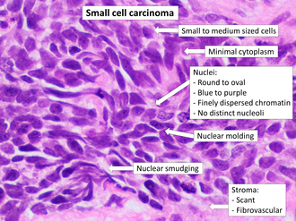 Microscopic image of lung tissue. Cells are small to medium sized with minimal cytoplasma. Nuclei are smudged, round to oval, blue to purple, with finely dispersed chromatin and without distinct nucleoli. Some nuclei are moulded together. Stroma is scant and fibrovascular.