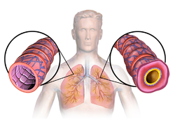 Asthma is considered an inflammatory-mediated disorder. On the right is an inflamed airway due to asthma.