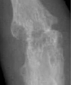 Closeup of bone erosions in rheumatoid arthritis[82]