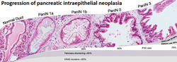 Progression of pancreatic intraepithelial neoplasia, including mutations[50]