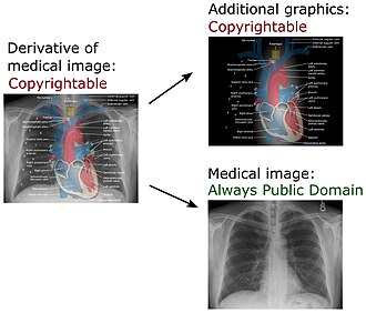 In a derivative of a medical image created in the U.S., added annotations and explanations may be copyrightable, but the medical image itself remains public domain.