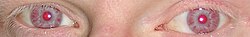 Red-appearing albino eyes