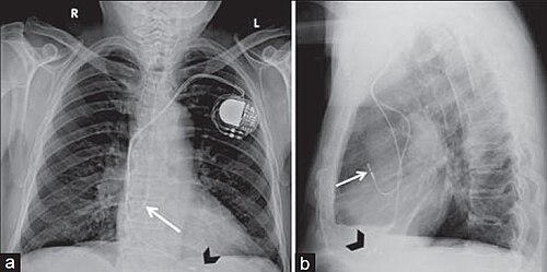 Posteroanterior and lateral chest radiographs of a pacemaker with normally located leads in the right atrium (white arrow) and right ventricle (black arrowhead), respectively