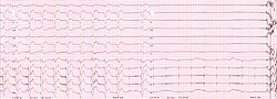 ECG rhythm strip of a threshold determination in a patient with a temporary (epicardial) ventricular pacemaker. The epicardial pacemaker leads were placed after the patient collapsed during aortic valve surgery. In the first half of the tracing, pacemaker stimuli at 60 beats per minute result in a wide QRS complex with a right bundle branch block pattern. Progressively weaker pacing stimuli are administered, which results in asystole in the second half of the tracing. At the end of the tracing, distortion results from muscle contractions due to a (short) hypoxic seizure. Because decreased pacemaker stimuli do not result in a ventricular escape rhythm, the patient can be said to be pacemaker-dependent and needs a definitive pacemaker.
