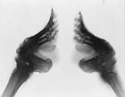 Foot binding, a practice commonly inflicted on Chinese women between the 10th century and the early 20th century. The image shows an X-ray of two bound feet.
