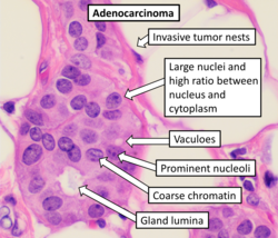 A large proportion of cancers are adenocarcinomas, with typical histopathology features shown, although they vary substantially from case to case.